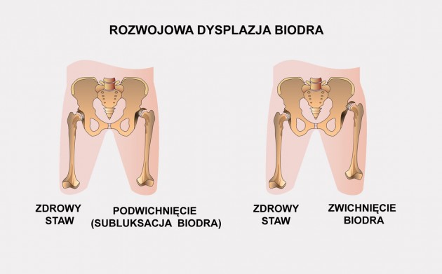 pieluchy na dysplazje stawu biodrowego